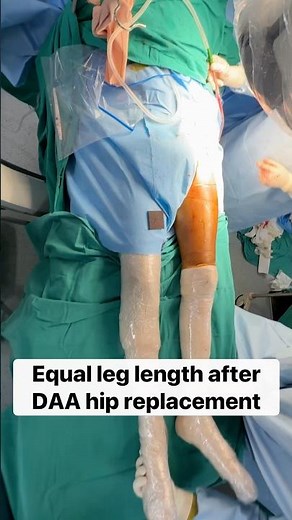 Live Xray-DAA Hip Replacement #minimallyinvasivesurgery #totalhipreplacement