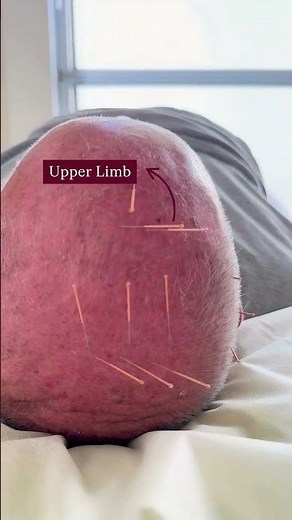 From Wheelchair To Walking After Stroke Using Zhu’s Scalp Acupuncture