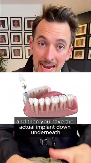 How Dental Implants Actually Work – Crown, Abutment & Root #dentalimplants #procedure