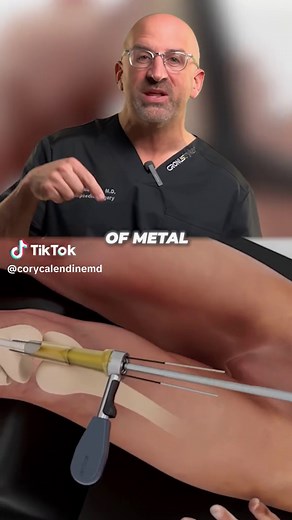 Tibia Fracture Nail Fixation Intramedullary nailing is minimally invasive and effective treatment option for extraarticular distal tibial fractures. Advantages over traditional open reduction and plate fixation can include shorter operative times and reduced risk of wound complications. Studies have shown that suprapatellar insertion technique significantly reduces the incidence of malunion, allowing for better maintenance of reduction during reaming and nail insertion. Plus, this technique does