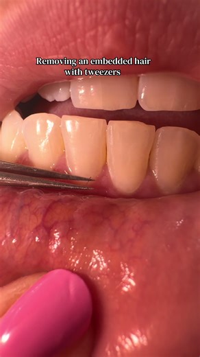Removing a hair that was embedded in gum tissue with tweezers! WEIRD! #pimplepopping #tweezers #extractions #esthetician