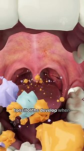 How Tonsil Stones Are Formed #short #tonsilstones . #doctor #documentaryphotography #DoctorWho # reel # shorts #DoctorWh# | SMART Doctor