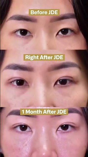 Before and After Double Eyelid Procedure
