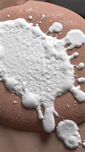 Asbestosis Pleural Plaques