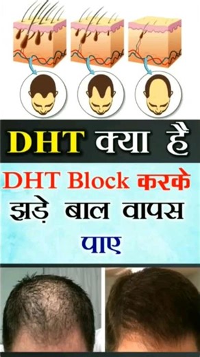 DHT Blocker | What is DHT and how we can regrow hairs by blocking DHT #dhtblocker #hairregrowth