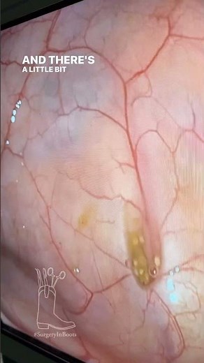 Diverticulosis explained from the inside!