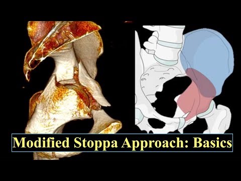 Modified Stoppa approach to the acetabulum: Basics for PGs and Residents
