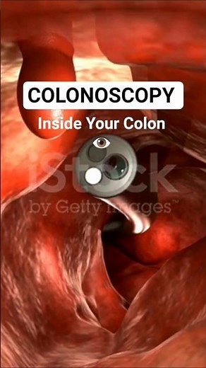 What Happens During a Colonoscopy ?
