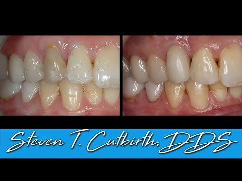 Anterior Implant & Crown - Seating Implant Crown