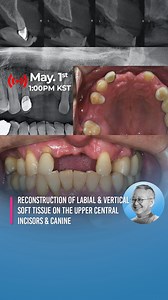 2.4K views · 15 reactions | Reconstruction of labial & vertical soft tissue on the upper central incisors & canine What surgical methods might be available?樂 Please consider and join our live surgery. YouTube ▶️Dr. Park's Implant Surgery Room Find out the channel linked in the bio! #edentulous #maxilla #molar #anterior #MegaGen | MegaGen Implant | Facebook