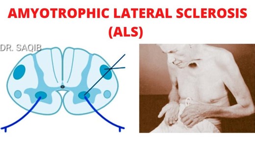 Amyotrophic Lateral Sclerosis (ALS)