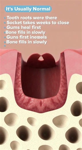 Seeing a hole in your gum after a tooth extraction? 😳🦷