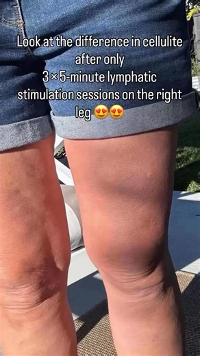 Shiatsu Lymphatic Drainage Care Worldwide on Instagram: "Look at the difference in cellulite after only 3 × 5-minute lymphatic stimulation sessions 👀 When fluid gets stuck, skin looks: • dimpled • uneven • puffy ✨ Once the lymphatic system is stimulated: ✔ fluid moves ✔ inflammation drops ✔ skin looks smoother & firmer This is why short, targeted sessions work. Start today comment with yes ) #Cellulite #CelluliteReduction #LymphaticDrainage #LymphaticHealth #Depuffing #FluidRetention #Inflammat