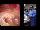 Endoscopic Ear Dissection - Part I • Video • MEDtube.net