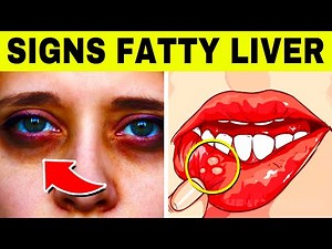 9 Common and Ignored Signs of FATTY LIVER (Hepatic Steatosis)