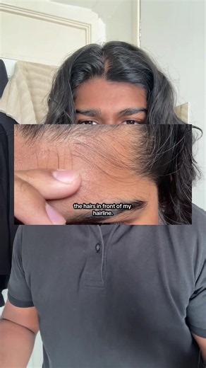 Hair Growth Journey: 1 Year Diffuse Thinning Transformation