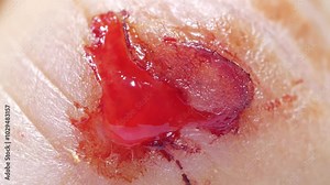 Injury to middle finger of right hand with bleeding. Flayed skin, red blood and lymphatic fluid flows from wound. 4K macro shot zoom-out video