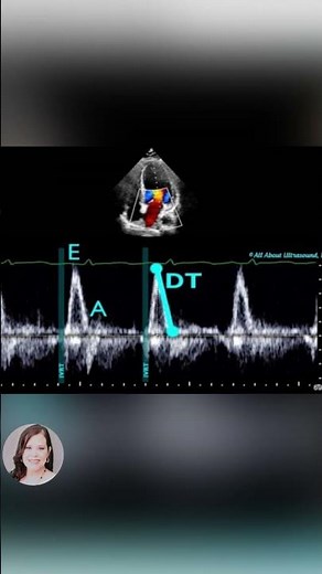 Grade 3 Left Ventricular Diastolic Dysfunction
