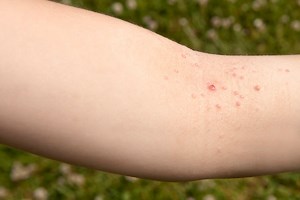 Molluscum contagiosum : tout savoir sur cette maladie de la peau