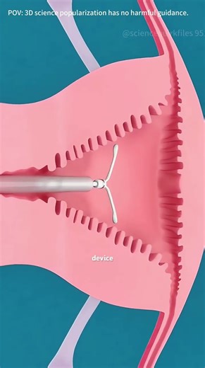 Intrauterine Device For Birth Control#iud #pregnancy #intrauterinedevice #birthcontrol #iudinsertion