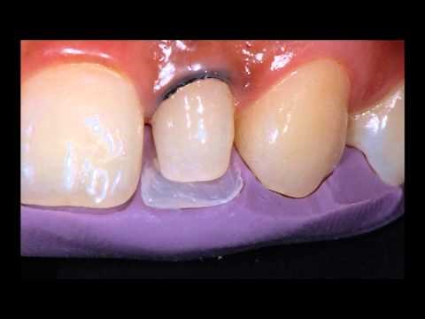 Dr Anthony Tay - 3M ESPE Filtek Z350XT Anterior Composite Layering of a Peg Lateral Incisor