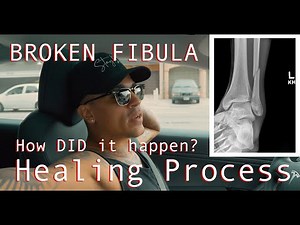 Broken Fibula, How I broke it, how I healed it.
