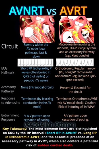 🔍 AVNRT vs. AVRT : Cheat Sheet differences between the two most common SVTs. #Cardiology #SVT #ECG #arrhythmia | Abdallah Othman