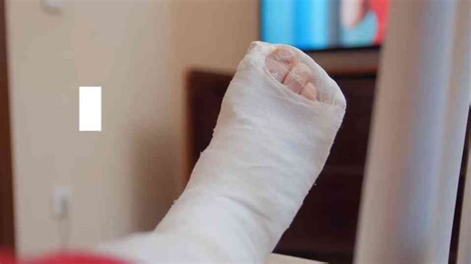 Can I Get My Cast Wet And When Is It Coming Off | Doctors explain