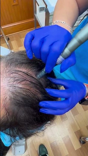 Micro-Needling for a Scalp PRP