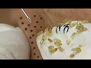 Loan Nguyen Acne Treatment (#150)