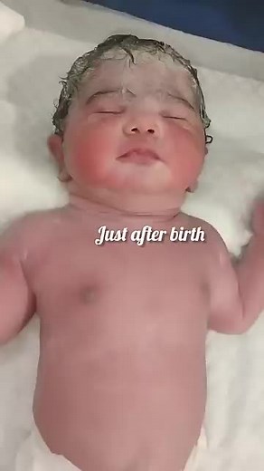 Just After Birth: Exploring Crossed Eye Conditions