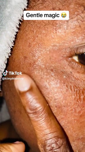 Gentle Magic Skincare Routine and Before/After Results