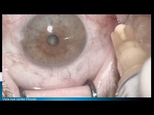 Subtenon triamcionolon Lukan Mishev Live Stream