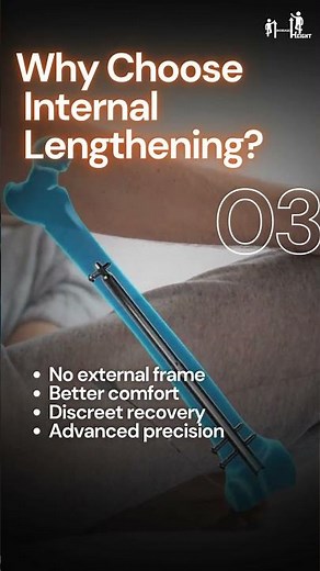 FITBONE Internal Limb Lengthening Explained | Invisible Height Increase Surgery