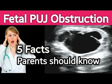Fetal Dilated Renal Pelvis - PUJ obstruction |- 5 Surprising Facts for Parents