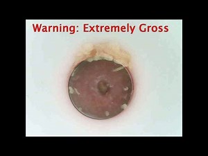 WARNING: Gross Black Head Removal | How to Remove Blackheads Yourself | w/ Wifi Camera | DIY
