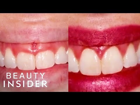 Gum Contouring Can Transform Your Smile
