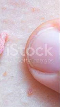 How to Get Rid of Warts Fast (Easy Home Remedies That Actually Work!)