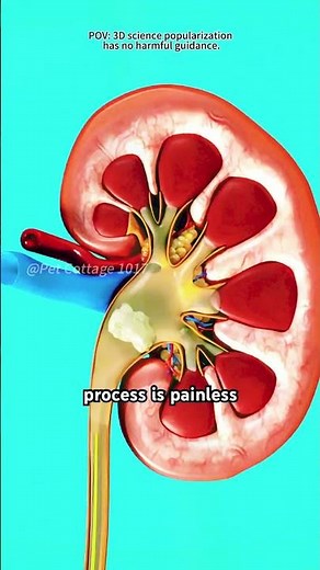 Ureteroscopy Procedure (3D Animation)