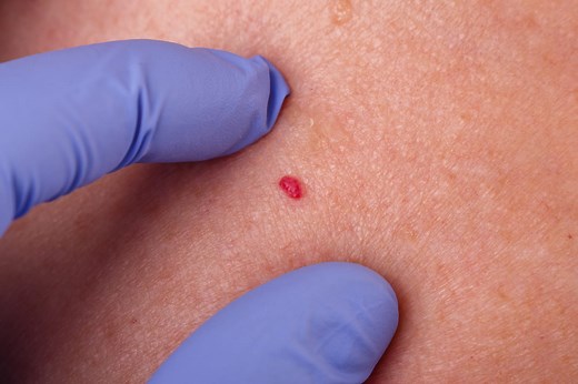 Angiome : photo pour le reconnaître, traitements