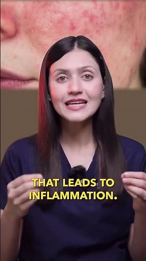 Are seborrheic dermatitis and dandruff the same thing? || Dr. Sarin ||