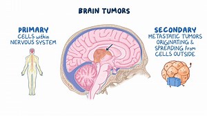Video: Brain tumors: Nursing - Video Explanation! | Osmosis | Osmosis