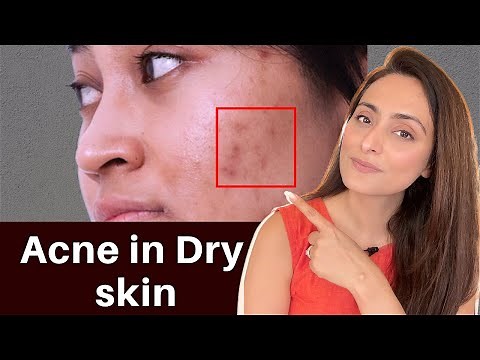 Acne in Dry Skin | what to use | serums, creams | Dermatologist recommends