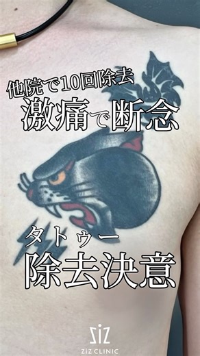 タトウー除去・アートメイク除去・傷跡修正/zizCLINIC院長 村岡史子 on Instagram: "・Pico+N-DERM（ピコダーム） 当院一番人気の施術です🥇 日本初導入のN-DERMと ピコレーザーの組み合わせです。 色素の深い部分を細かくくり抜き、 さらにマクロファージの貪食を高めることで ピコレーザー単体での施術より、 施術回数を4割少なく、 治療期間も約半分に軽減することができます👌 また、傷跡ケア治療が含まれるので コスパが良いととても人気です！ 【通常料金】 1～5㎠未満：￥60,000（税込） 6～10㎠未満：￥90,000（税込） 11～30㎠未満：￥150,000（税込） 31～50㎠未満：￥210,000（税込） 51～100㎠未満：￥300,000（税込） ⚠️痛み・赤み・かゆみ・色素沈着・ 水ぶくれ・浮腫・感染 ※当院では痛みに対する ストレス軽減のために 静脈麻酔のご提案をしております。 ┈┈┈┈┈┈┈┈┈┈┈┈┈┈┈┈┈┈┈ ziz CLINIC 〒150-0042 東京都渋谷区宇田川町36-1 SANWA SHI