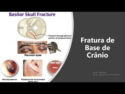 10 Sinais de Fratura de Base de Crânio e os Cuidados de Enfermagem