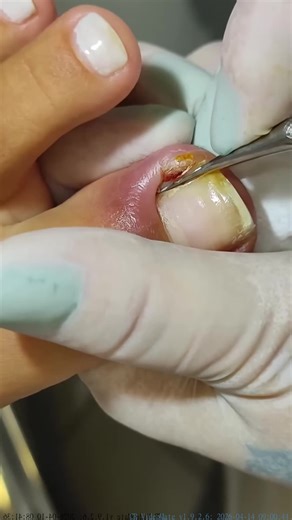 #unhaencravada #ingrowntoenail #unhasencravadas #ingrowntoenailremoval #uñaencarnada_10 (311)_done