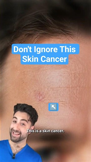 Don't Ignore This Skin Cancer!