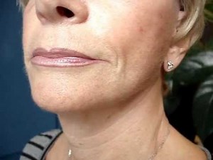 lifting du cou,neck lift before after,dr vladimir mitz