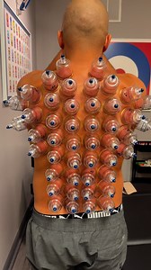 🏆 Cupping Therapy Cupping—sometimes called myofascial decompression—uses gentle suction to lift the skin and fascia, helping tight muscles release while improving blood flow. This decompression effect allows oxygen and nutrients to reach areas of tension more effectively, which can ease soreness, reduce stiffness, and support recovery. Many people notice relief in their back, shoulders, and legs, making cupping a valuable tool for both athletes and everyday patients. The circular marks that app