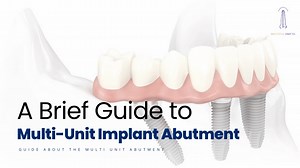 A Brief Guide to Multi-Unit Implant Abutment - SlideServe